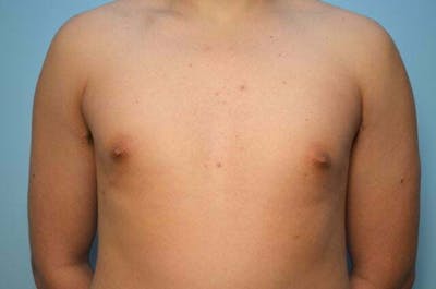 Male Procedures by Dr. Hess Before & After Gallery - Patient 718200 - Image 1
