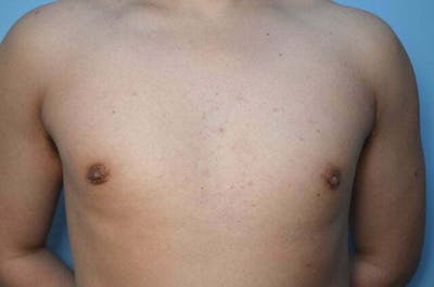 Male Procedures by Dr. Hess Before & After Gallery - Patient 718200 - Image 2