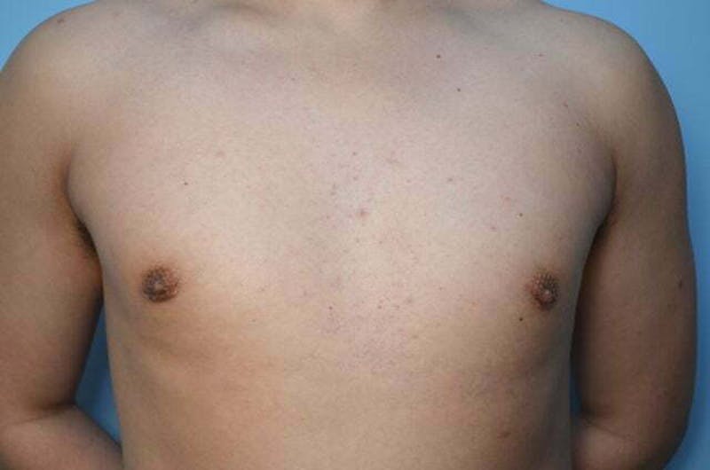 Male Procedures by Dr. Hess Before & After Gallery - Patient 718200 - Image 2