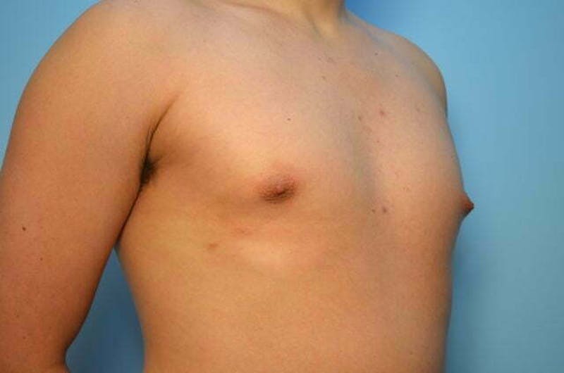 Male Procedures by Dr. Hess Before & After Gallery - Patient 718200 - Image 3