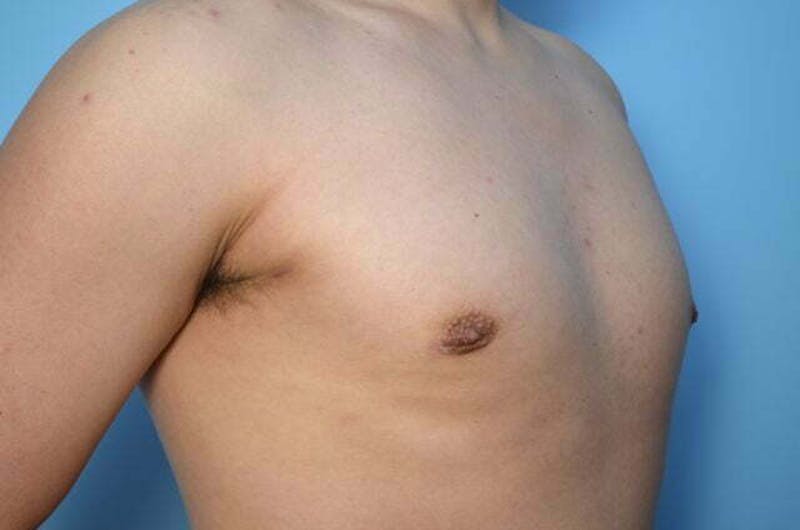 Male Procedures by Dr. Hess Before & After Gallery - Patient 718200 - Image 4