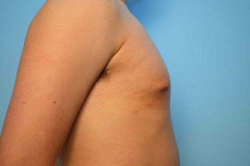 Male Procedures by Dr. Hess Before & After Gallery - Patient 718200 - Image 5