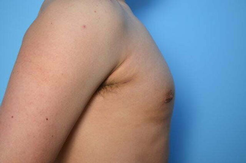 Male Procedures by Dr. Hess Before & After Gallery - Patient 718200 - Image 6