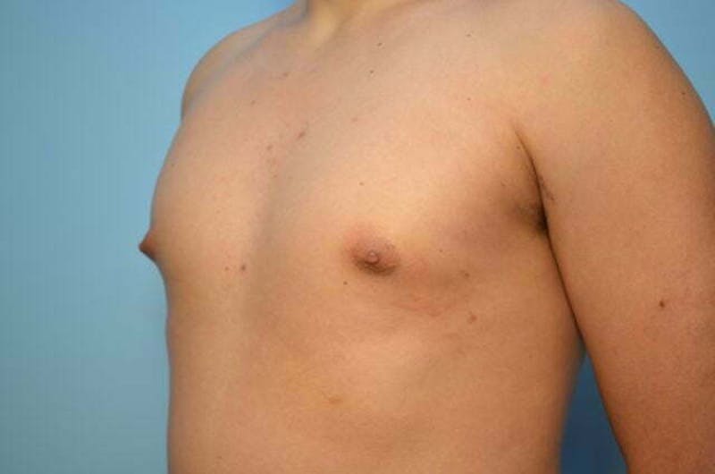Male Procedures by Dr. Hess Before & After Gallery - Patient 718200 - Image 7