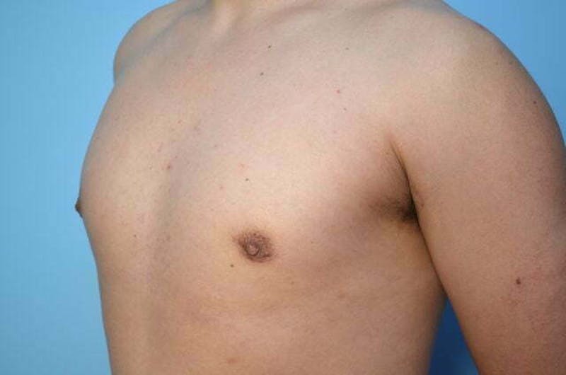 Male Procedures by Dr. Hess Before & After Gallery - Patient 718200 - Image 8
