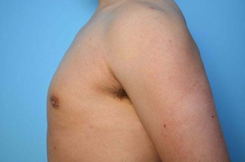 Male Procedures by Dr. Hess Before & After Gallery - Patient 718200 - Image 10