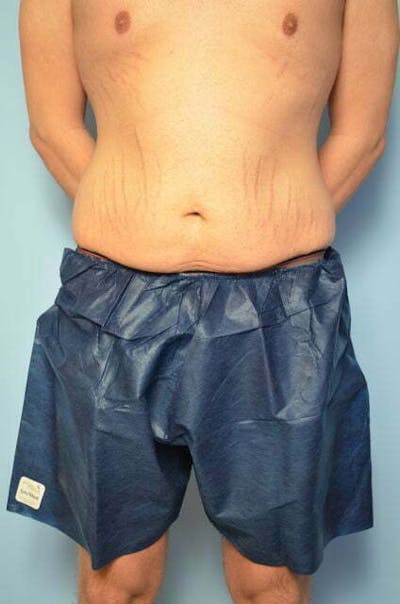 Male Procedures by Dr. Hess Before & After Gallery - Patient 154410 - Image 1