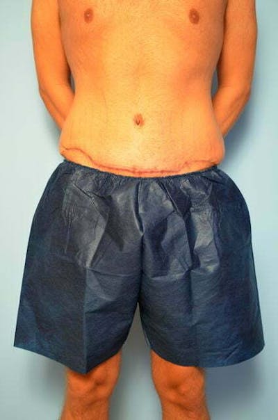 Male Procedures by Dr. Hess Before & After Gallery - Patient 154410 - Image 2