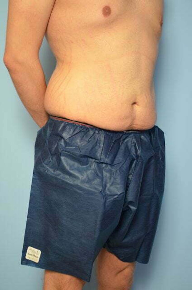 Male Procedures by Dr. Hess Before & After Gallery - Patient 154410 - Image 3