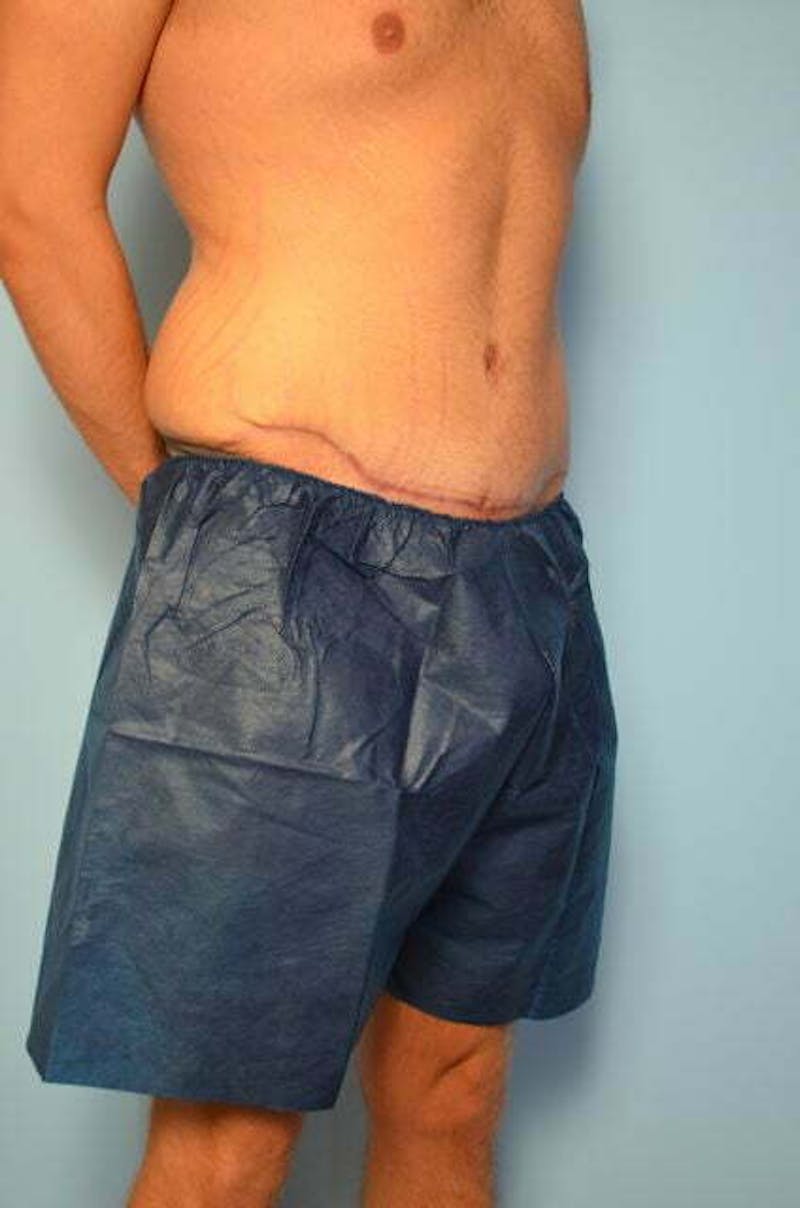 Male Procedures by Dr. Hess Before & After Gallery - Patient 154410 - Image 4