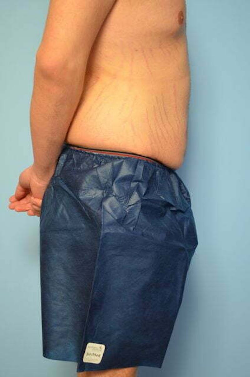 Male Procedures by Dr. Hess Before & After Gallery - Patient 154410 - Image 5