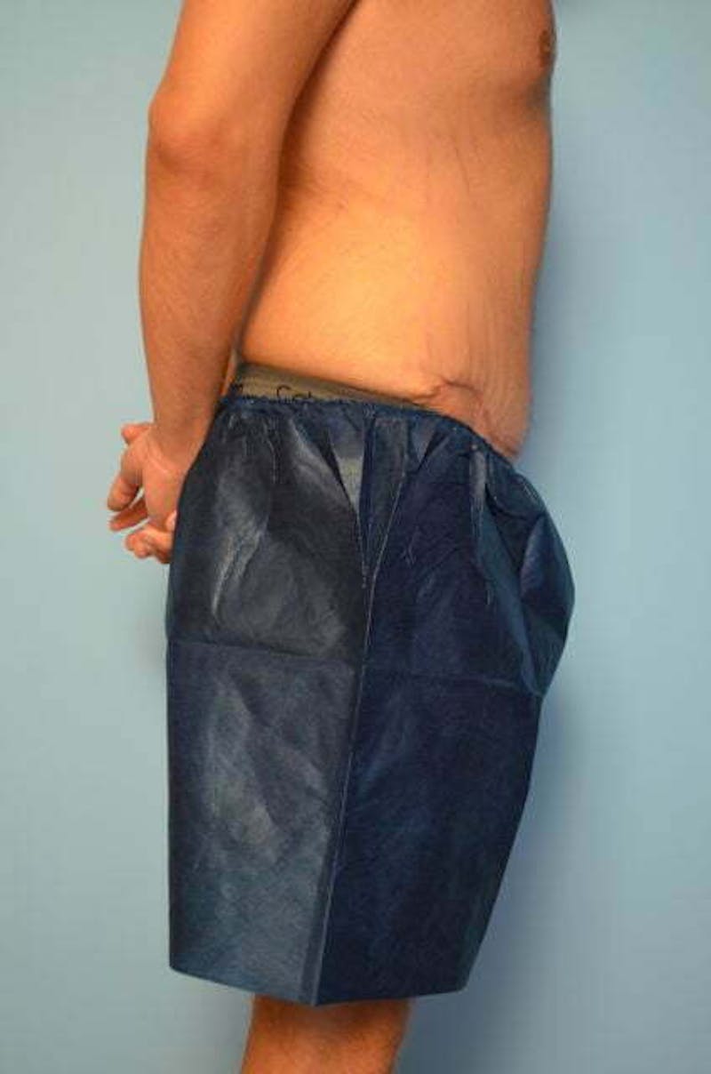 Male Procedures by Dr. Hess Before & After Gallery - Patient 154410 - Image 6