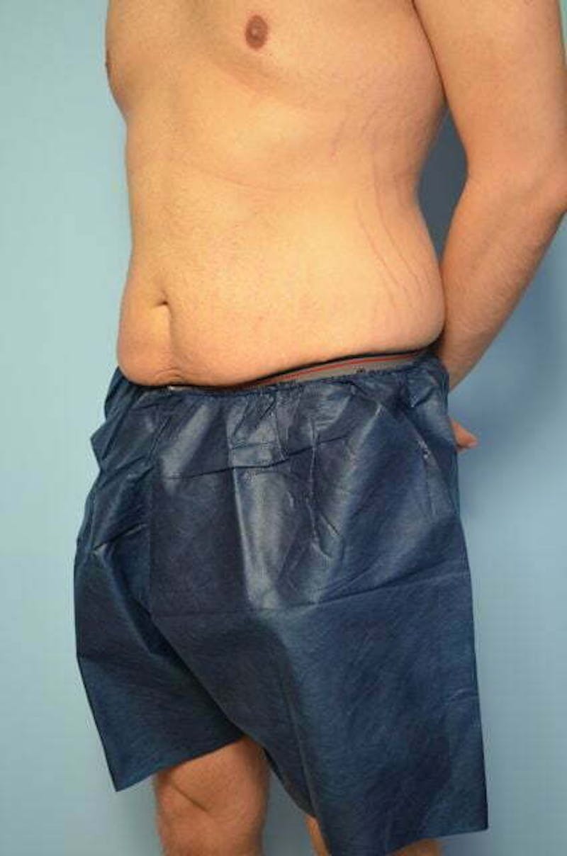 Male Procedures by Dr. Hess Before & After Gallery - Patient 154410 - Image 7