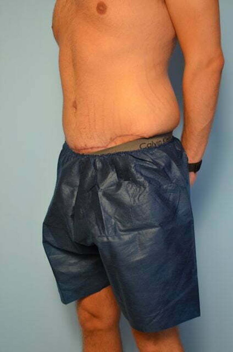 Male Procedures by Dr. Hess Before & After Gallery - Patient 154410 - Image 8
