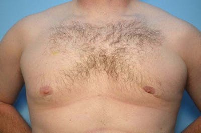 Male Procedures by Dr. Hess Before & After Gallery - Patient 120450 - Image 1