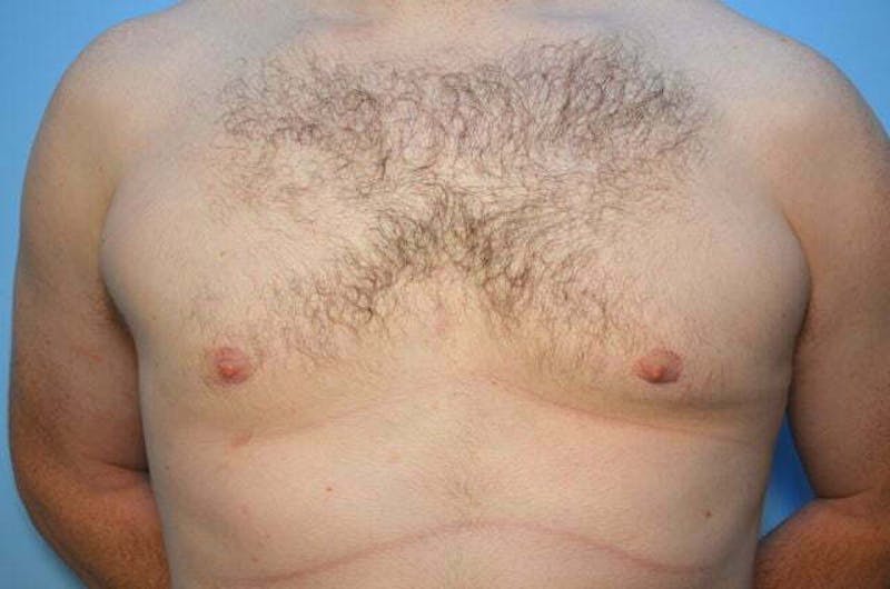 Male Procedures by Dr. Hess Before & After Gallery - Patient 120450 - Image 2