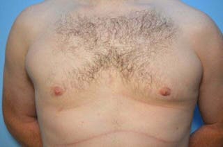 Male Breast Reduction Before & After Gallery - Patient 120450 - Image 2