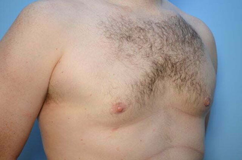 Male Procedures by Dr. Hess Before & After Gallery - Patient 120450 - Image 3