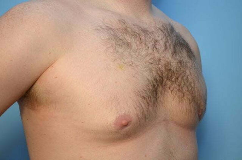 Male Procedures by Dr. Hess Before & After Gallery - Patient 120450 - Image 4