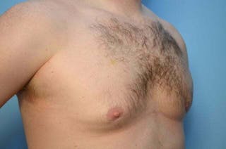 Male Breast Reduction Before & After Gallery - Patient 120450 - Image 4