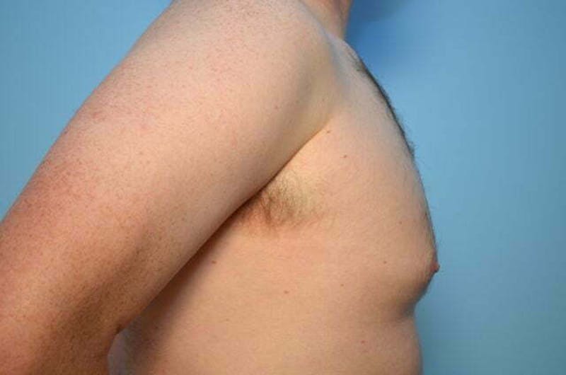 Male Procedures by Dr. Hess Before & After Gallery - Patient 120450 - Image 5