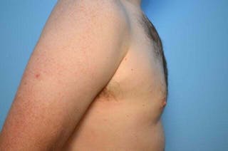 Male Breast Reduction Before & After Gallery - Patient 120450 - Image 6