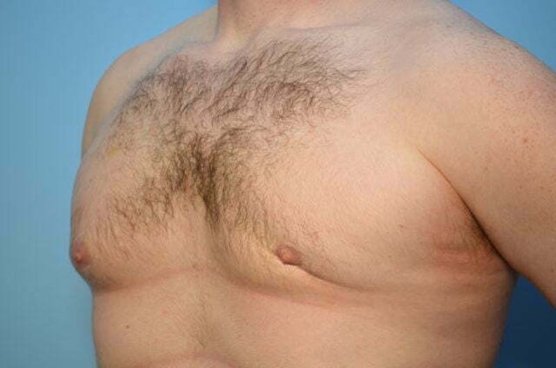 Male Procedures by Dr. Hess Before & After Gallery - Patient 120450 - Image 7