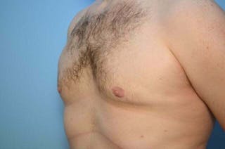 Male Breast Reduction Before & After Gallery - Patient 120450 - Image 8
