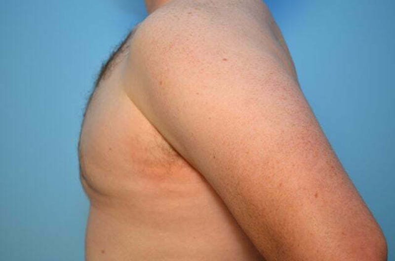 Male Procedures by Dr. Hess Before & After Gallery - Patient 120450 - Image 9