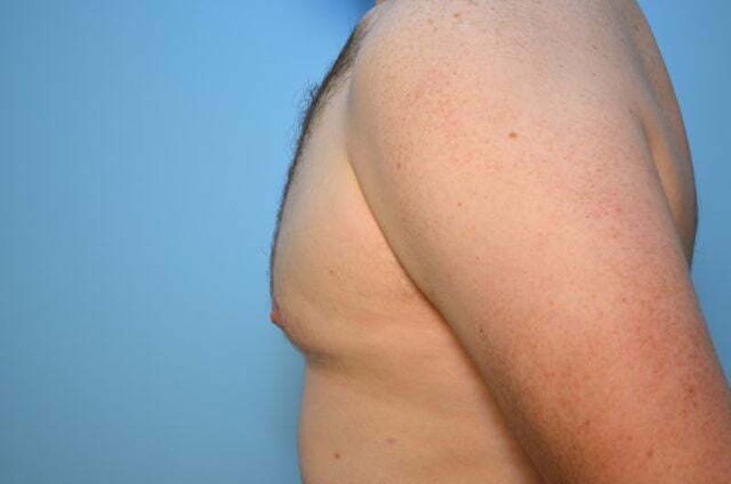 Male Procedures by Dr. Hess Before & After Gallery - Patient 120450 - Image 10