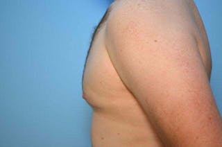 Male Breast Reduction Before & After Gallery - Patient 120450 - Image 10