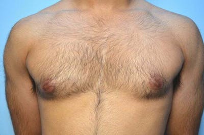 Male Procedures by Dr. Hess Before & After Gallery - Patient 380634 - Image 1