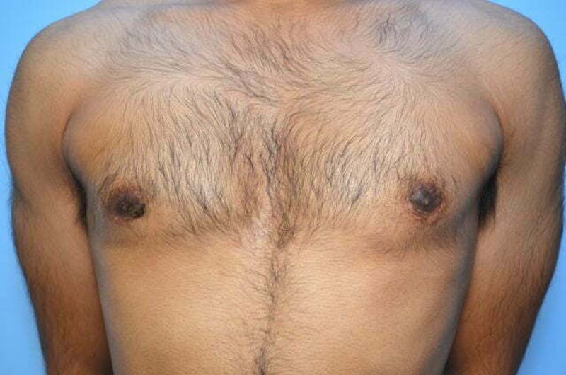 Male Procedures by Dr. Hess Before & After Gallery - Patient 380634 - Image 2