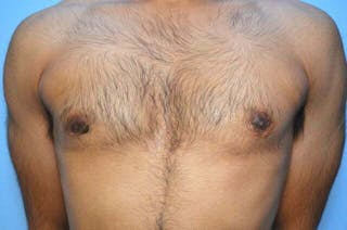Male Breast Reduction Before & After Gallery - Patient 380634 - Image 2