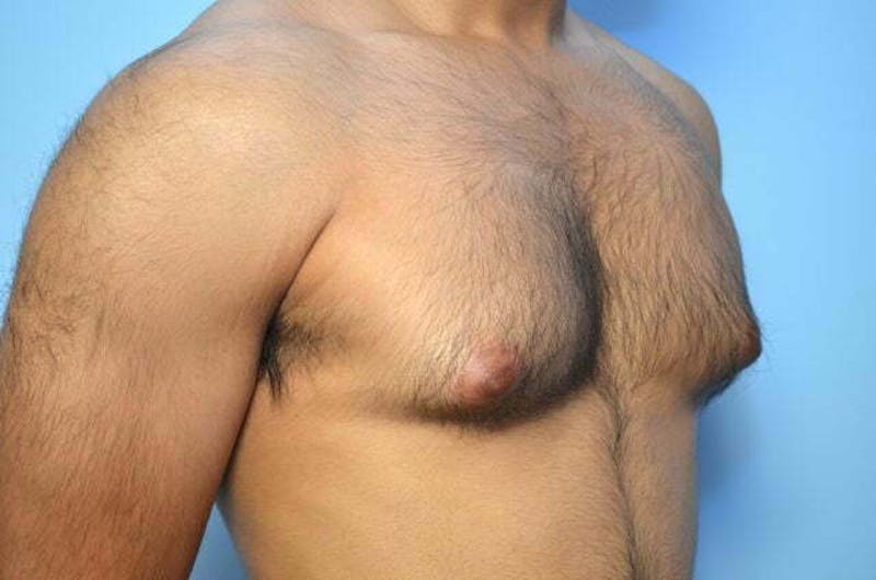 Male Procedures by Dr. Hess Before & After Gallery - Patient 380634 - Image 3