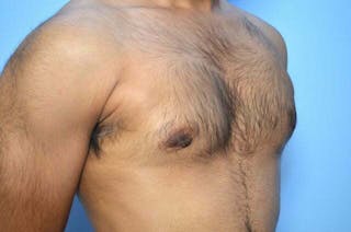 Male Breast Reduction Before & After Gallery - Patient 380634 - Image 4