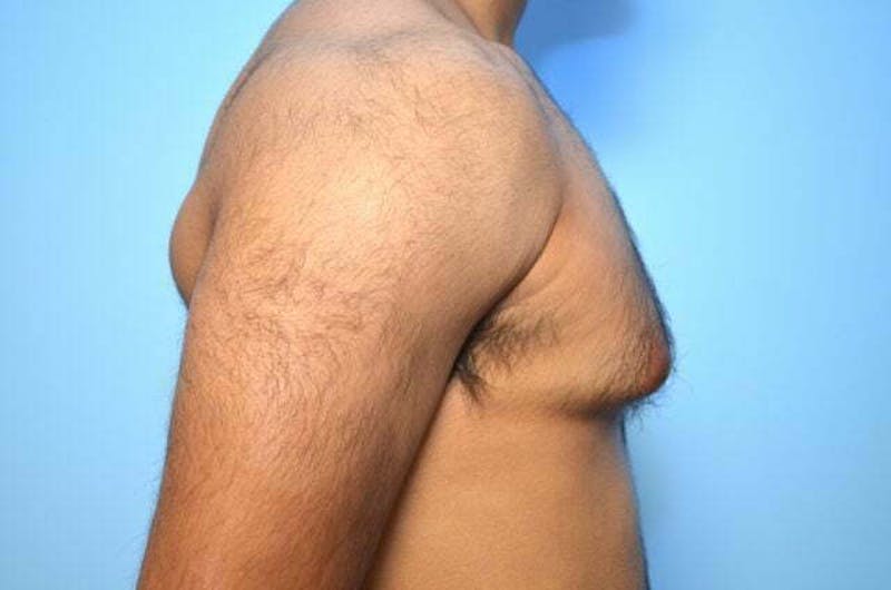 Male Procedures by Dr. Hess Before & After Gallery - Patient 380634 - Image 5