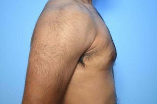 Male Breast Reduction Before & After Gallery - Patient 380634 - Image 6