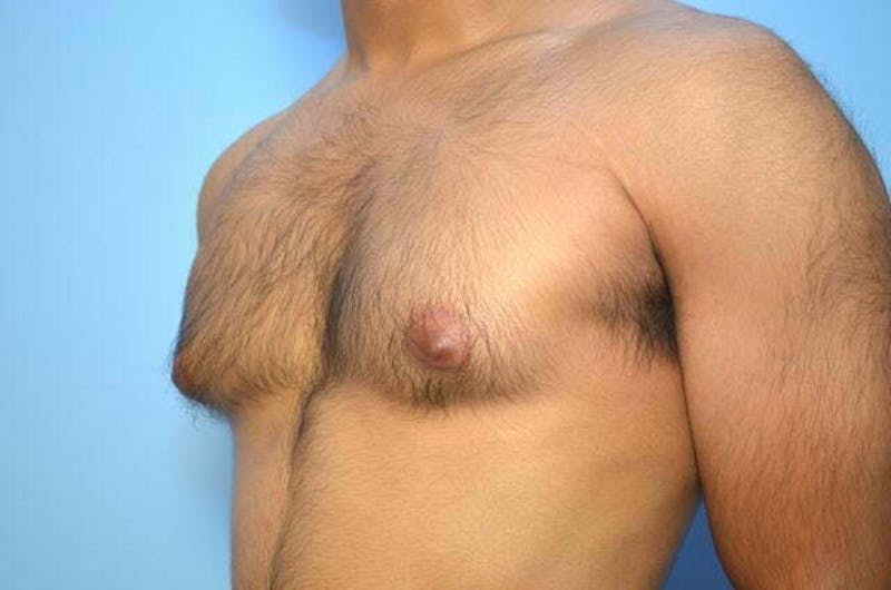 Male Procedures by Dr. Hess Before & After Gallery - Patient 380634 - Image 7
