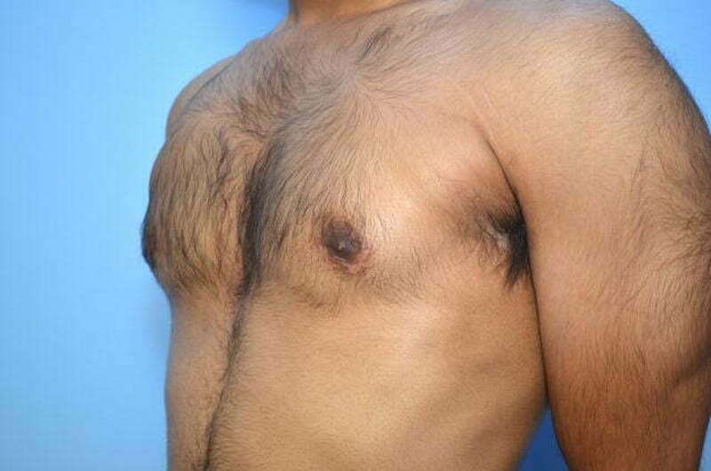 Male Procedures by Dr. Hess Before & After Gallery - Patient 380634 - Image 8
