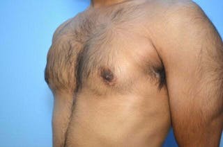 Male Breast Reduction Before & After Gallery - Patient 380634 - Image 8