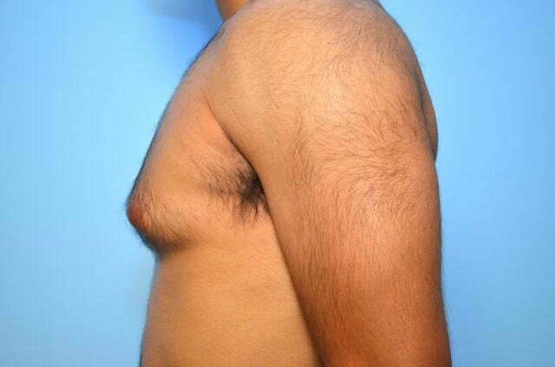 Male Procedures by Dr. Hess Before & After Gallery - Patient 380634 - Image 9