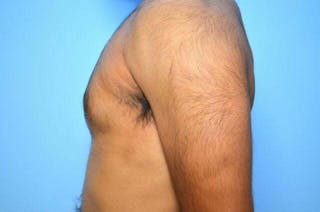 Male Breast Reduction Before & After Gallery - Patient 380634 - Image 10