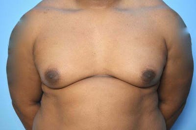 Male Procedures by Dr. Hess Before & After Gallery - Patient 417583 - Image 1