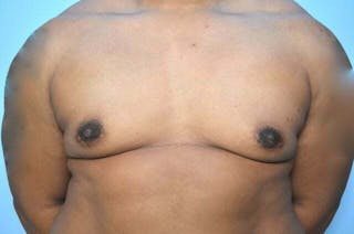 Male Breast Reduction Before & After Gallery - Patient 417583 - Image 2