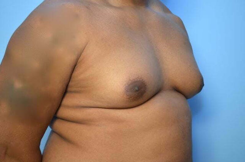 Male Procedures by Dr. Hess Before & After Gallery - Patient 417583 - Image 3