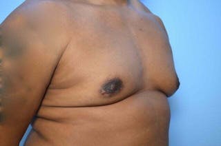 Male Breast Reduction Before & After Gallery - Patient 417583 - Image 4
