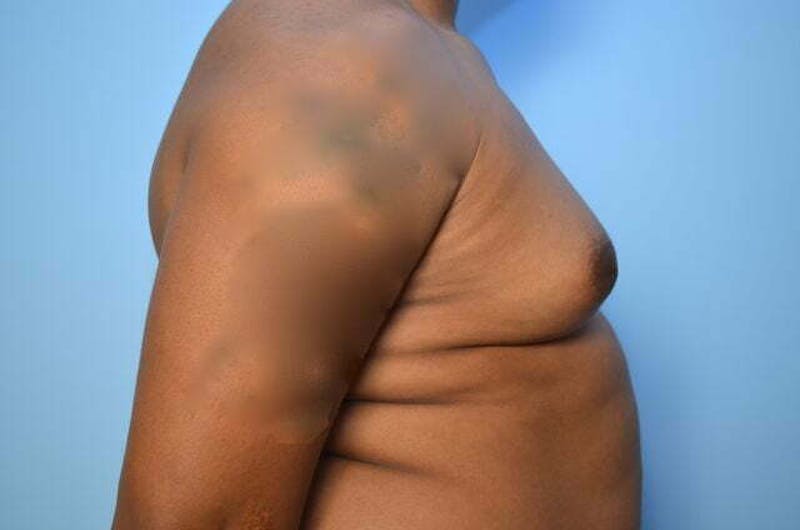 Male Procedures by Dr. Hess Before & After Gallery - Patient 417583 - Image 5