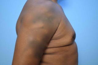 Male Breast Reduction Before & After Gallery - Patient 417583 - Image 6