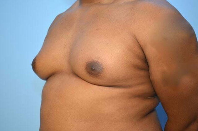 Male Procedures by Dr. Hess Before & After Gallery - Patient 417583 - Image 7